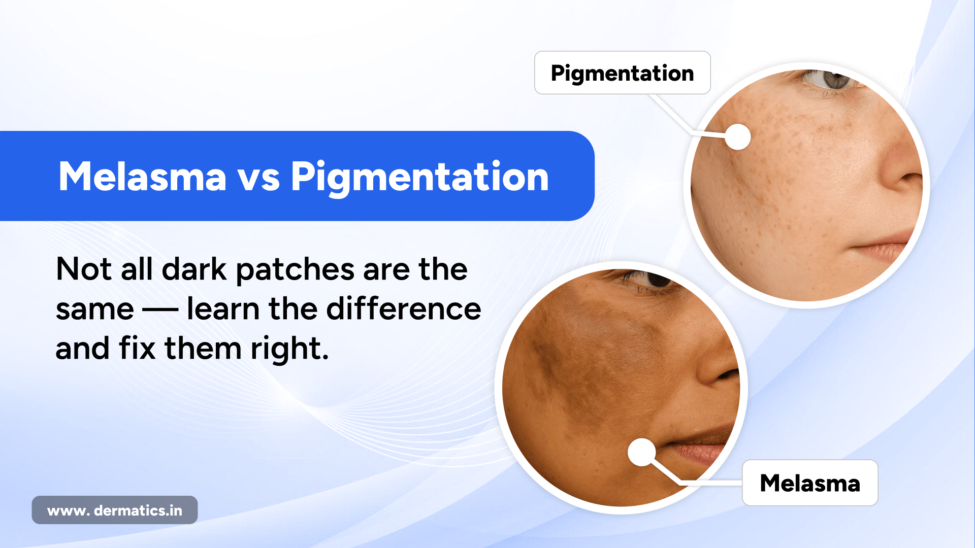 Melasma vs Hyperpigmentation: What’s the Difference and How to Treat Them
