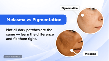 Melasma vs Hyperpigmentation: What’s the Difference and How to Treat Them