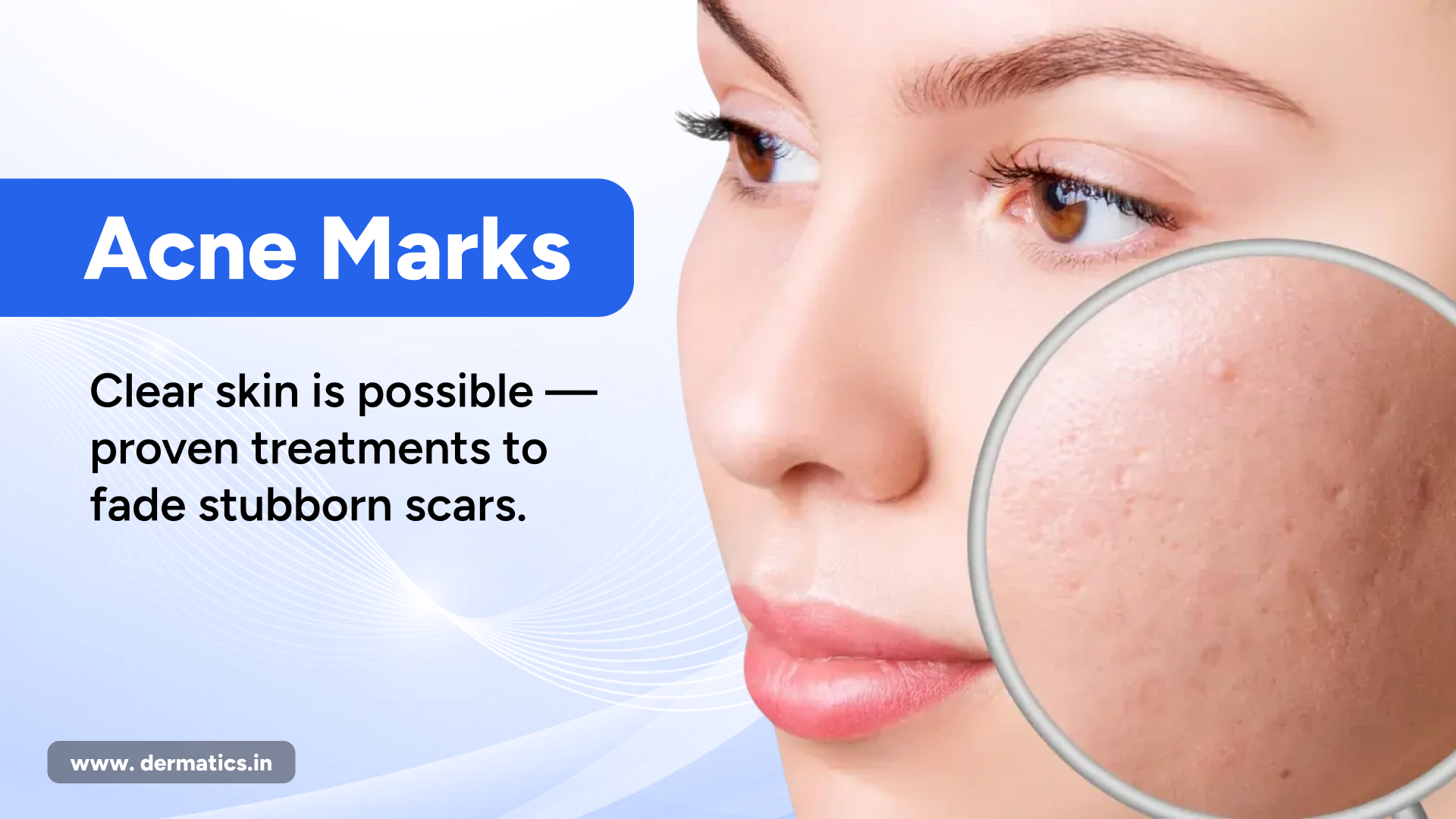 Proven Methods to Get Rid of Acne Scars and Marks for Clearer, Healthier Skin??