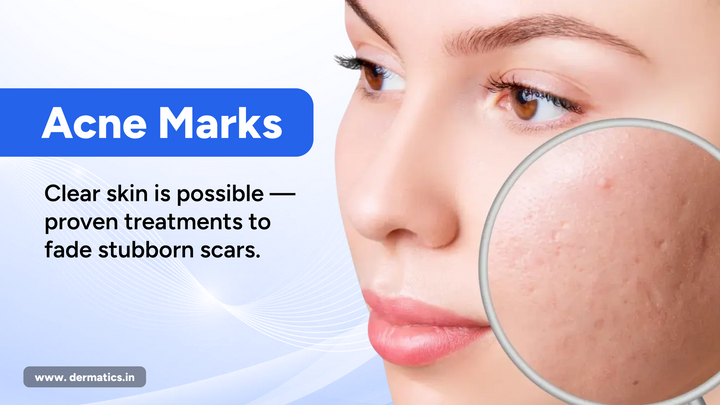 Proven Methods to Get Rid of Acne Scars and Marks for Clearer, Healthier Skin?