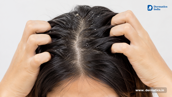 Online Dermatologist Consultation for Dandruff & Itchy Scalp: Causes, Treatment & Expert Help