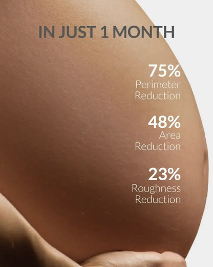AreoVeda Stretch Marks Cream 50gm
